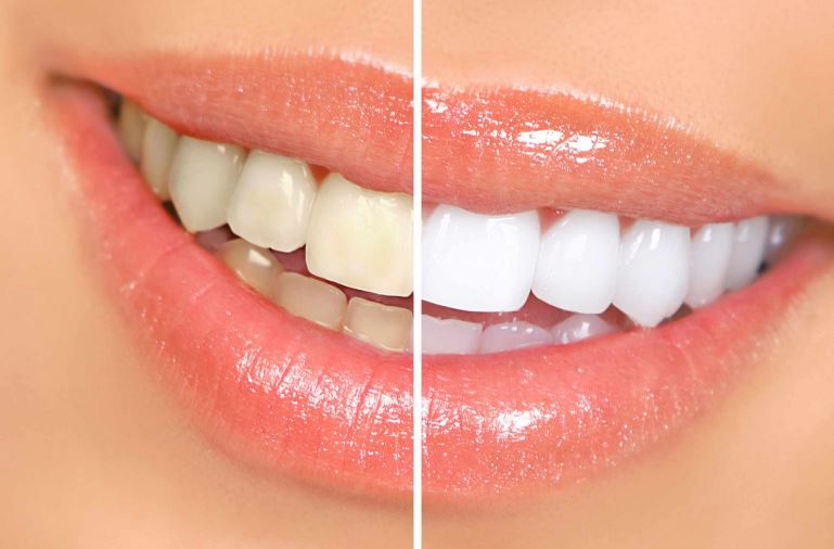 Teeth Whitening in South Africa… Advantages, Cost, How, Where..