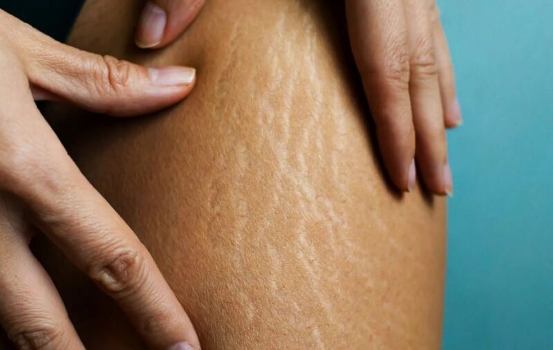 Stretch Marks Removal in South Africa. Everything You Need To Know