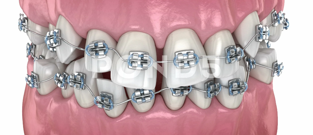 What's the Cost of Braces in South Africa?